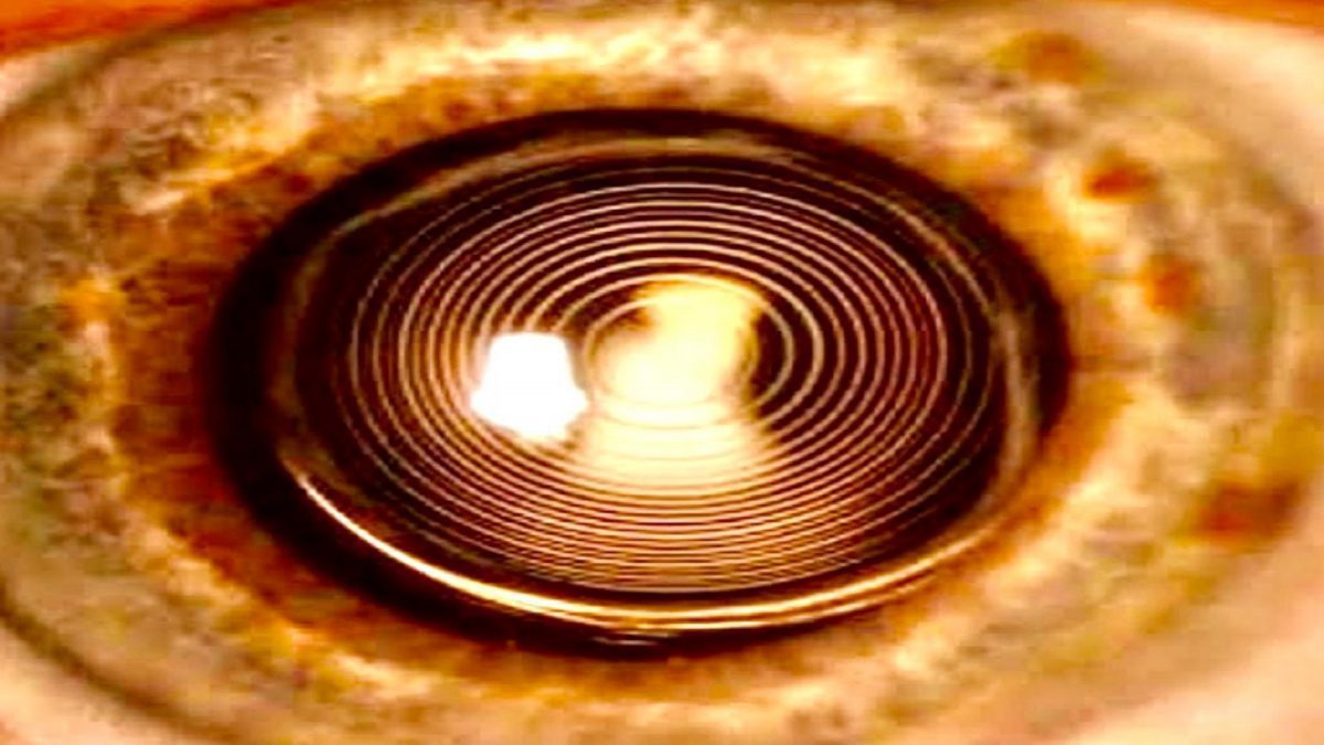 Smart Lenses Surgery in Antalya, Turkey Eye Surgery Antalya